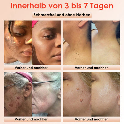 ✨[Offizieller Store] JEREMYTIS™ Peeling-Gel